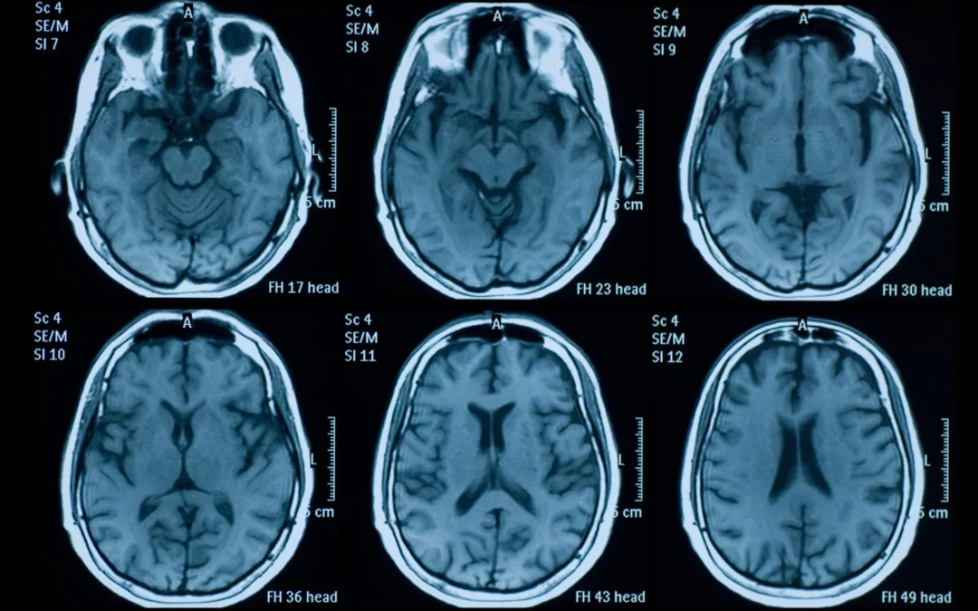 How to Realize Subtle Signs of Brain Injuries